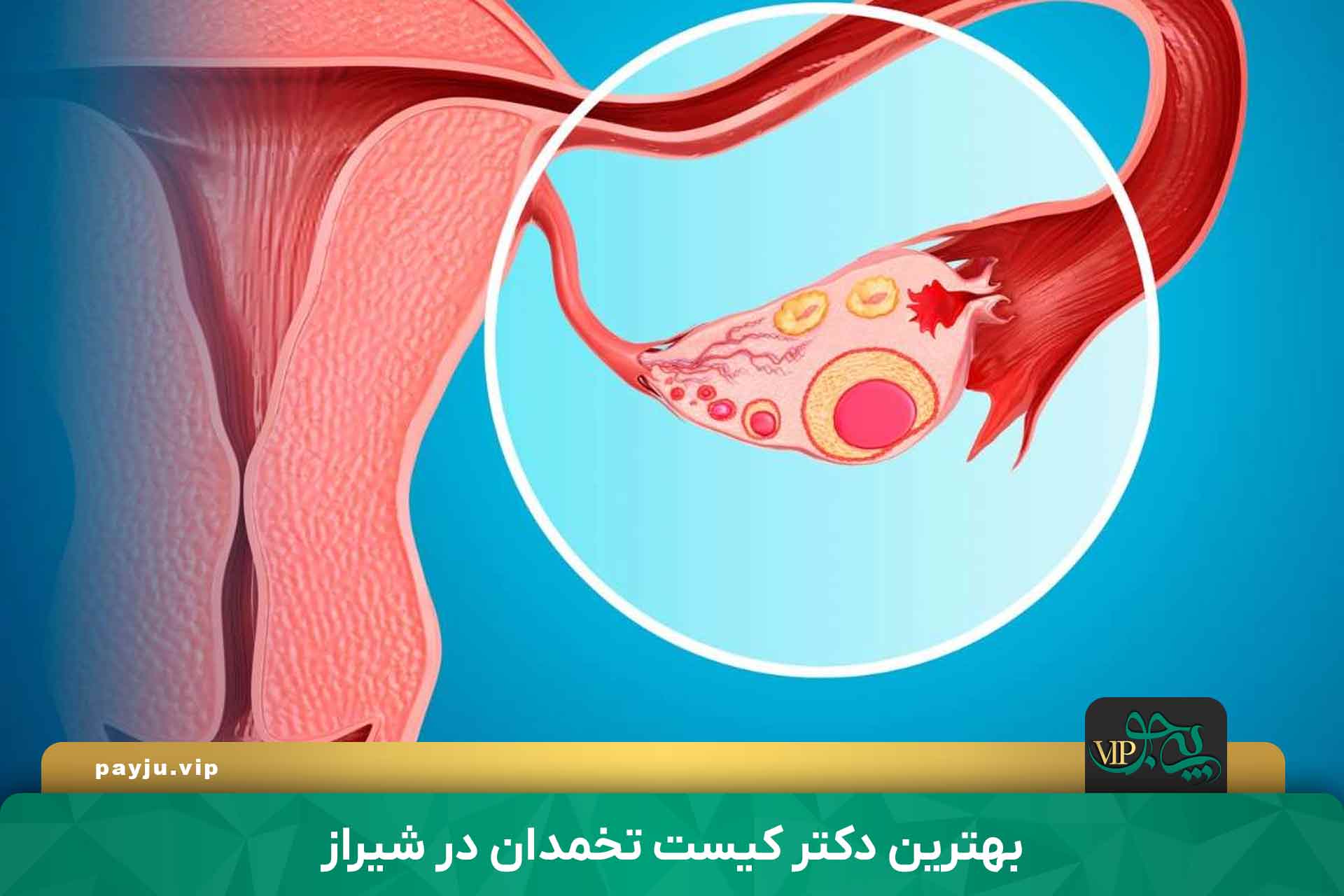 بهترین دکتر کیست تخمدان در شیراز
